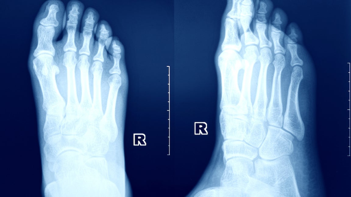 Stress fracture image of the food.