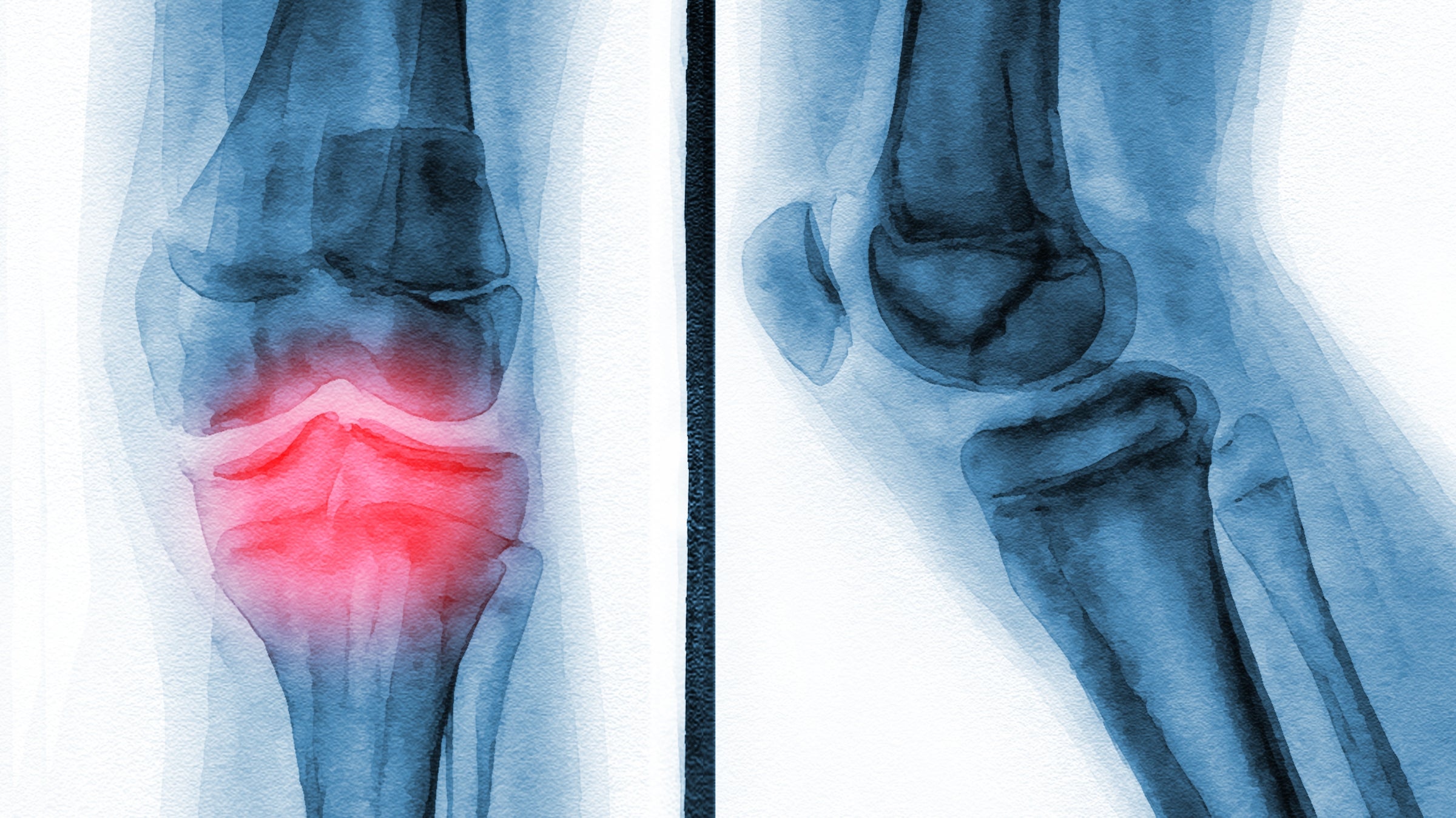 Illustration of a knee x-ray showing pain from arthritis