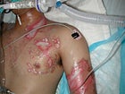 Ronnie Simpson's burns