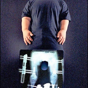 Profile of a Boy With Dwarfism