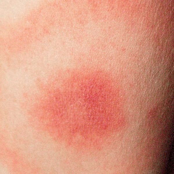 The Lyme bull's-eye