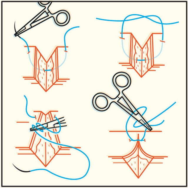 A closer look a the steps to stitching a wound