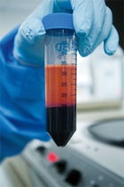 REgenexx stem cell surgery