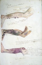 OutsideOnline scurvy leg criminals symptoms medical drawing Henry Walsh Mahon