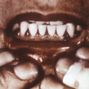 OutsideOnline scorbutic scurvy gums case fall out teeth Vitamin C